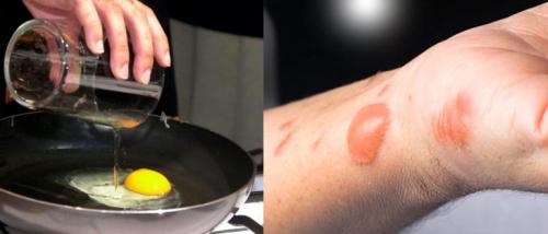 “Масло от ожога и ожоги маслом — правда и вымысел”