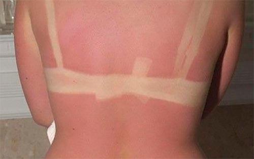 “Масло от ожога и ожоги маслом — правда и вымысел”