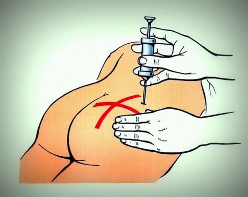 Внутримышечная инъекция в ягодицу: учимся делать самостоятельно. 01