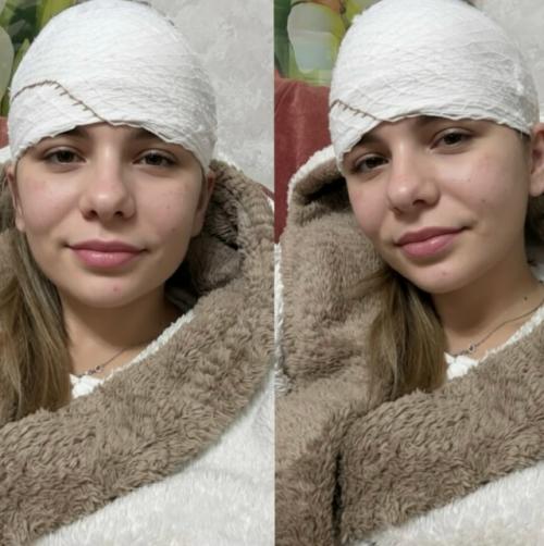 Девушка выдавила прыщ и оказалась на операционном столе с разрезанным лбом. 01