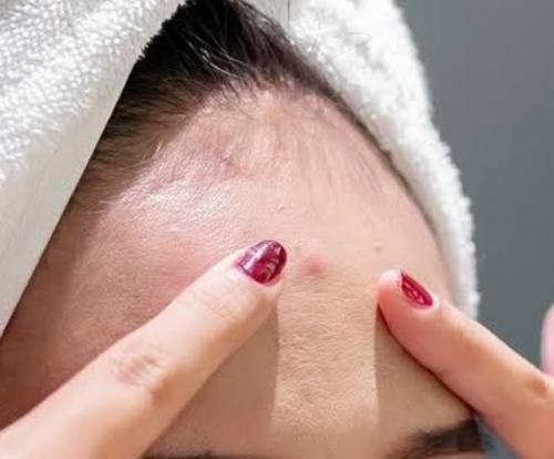 Девушка выдавила прыщ и оказалась на операционном столе с разрезанным лбом.

