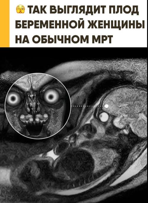 МРТ Плода показывает мозг и глаза сквозь кости черепа. 
