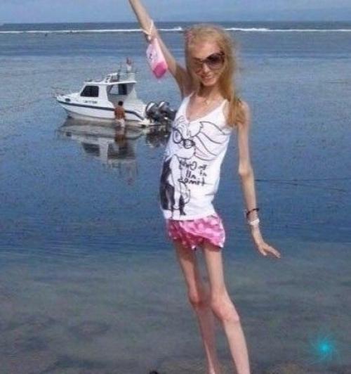 Сумела побороть анорексию. 04