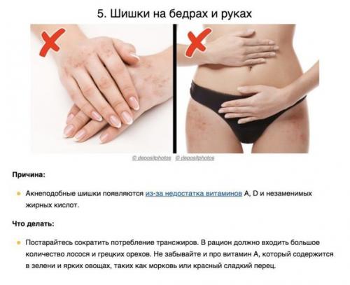 8 сигналов тела, которые помогают понять, каких витаминов не хватает вашему организму. 04