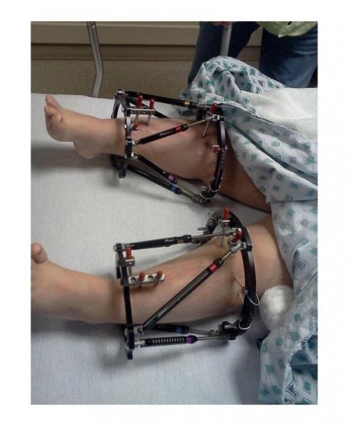 Вот что аппарат илизарова делает людей с карликовым ростом. 02