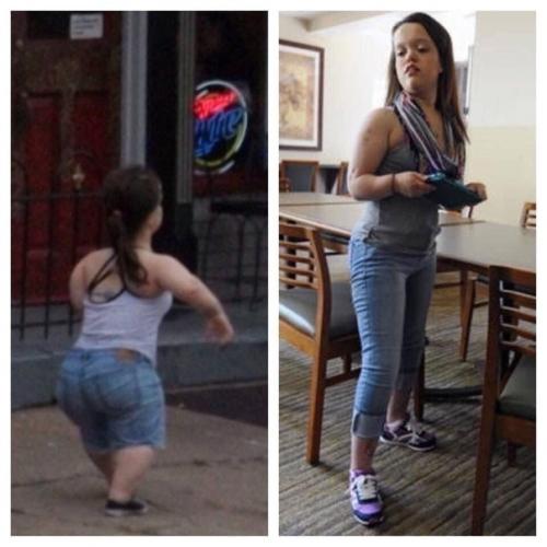 Вот что аппарат илизарова делает людей с карликовым ростом. 04