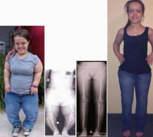 Вот что аппарат илизарова делает людей с карликовым ростом. 03