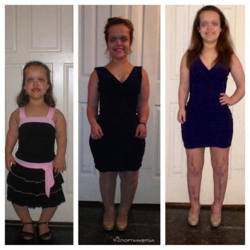 Вот что аппарат илизарова делает людей с карликовым ростом. 01